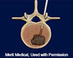 Spinal Ablation