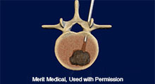 Spinal Ablation