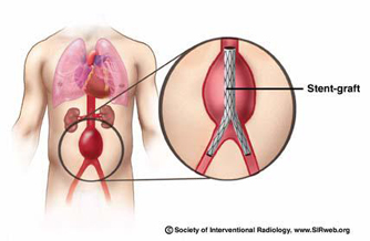 AORTIC STENT GRAFT (THORACIC AND ABDOMINAL)