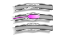 PERIPHERAL ARTERY DISEASE MANAGEMENT