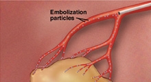 Embolization particles