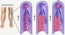Venous and Arterial Thrombolysis