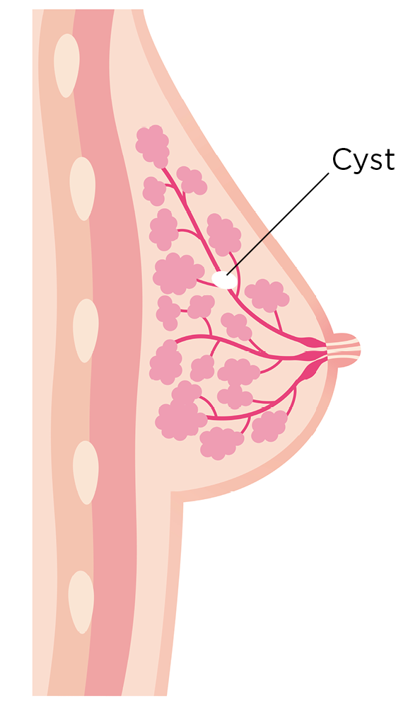 Breast Cyst CRL Women's Imaging