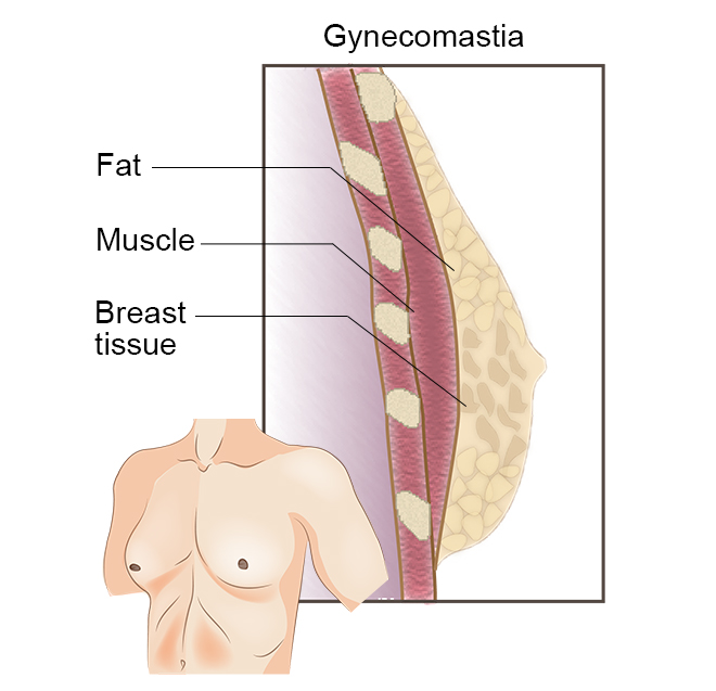 Gynecomastia CRL Women's Imaging