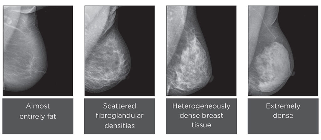 What Is Breast Density And Why Is It Important Consulting 
