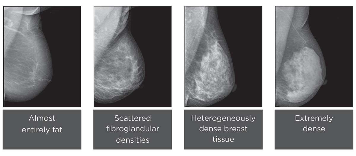 Breast Density Images
