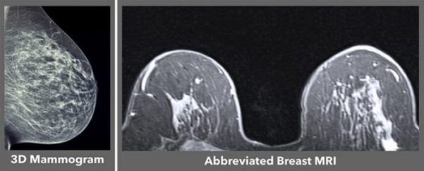 Abbreviated Breast Mri Results – TSMA