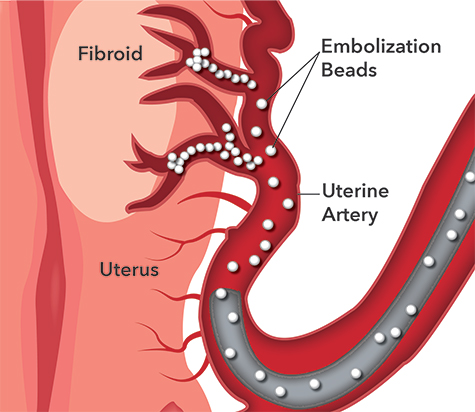 Uterine Fibroid Embolization (UFE)