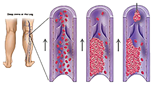 VENOUS AND ARTERIAL THROMBOLYSIS