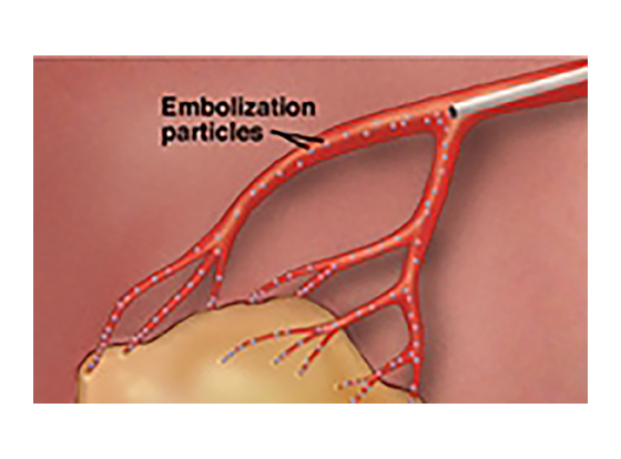 CHEMOEMBOLIZATION