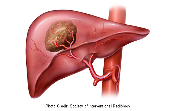 SELECTIVE INTERNAL RADIATION THERAPY