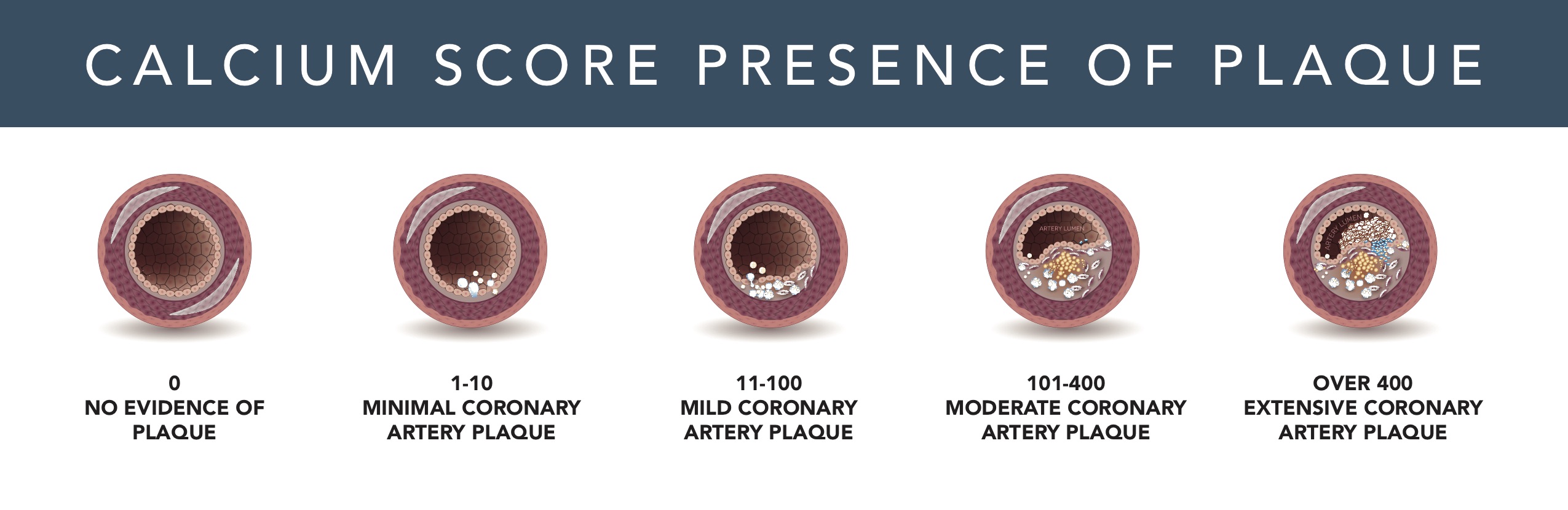 Calcium Score Presence of Plaque