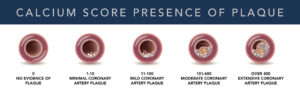 Calcium Score Presence of Plaque