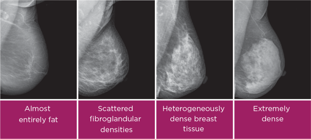 What is dense breast tissue? What are dense breasts?