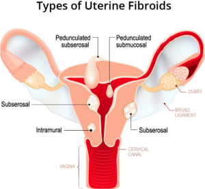 Types of Uterine Fibroids