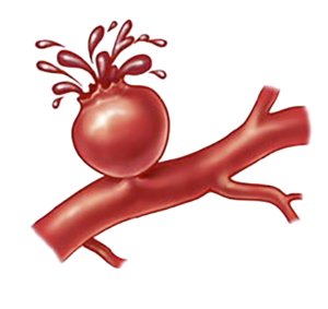 RupturedAneurysms Ruptured Aneurysm