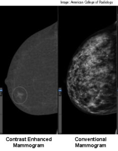 Contrast Enhances Mammogram vs. Traditional Mammogram